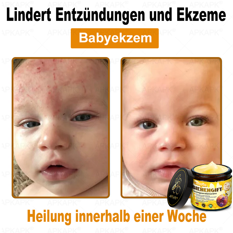 Hergestellt in Deutschland ✨APKAPK® Bienengift Hautregenerations creme – Anti-Aging, Feuchtigkeitsspendend, Hautreparatur, Hautbildverbesserung, Akne- und Pigmentfleckenbehandlung, Warzen- und Muttermalentfernung, Linderung bei Psoriasis
