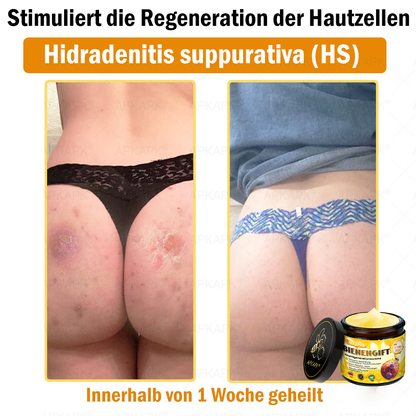 Hergestellt in Deutschland ✨APKAPK® Bienengift Hautregenerations creme – Anti-Aging, Feuchtigkeitsspendend, Hautreparatur, Hautbildverbesserung, Akne- und Pigmentfleckenbehandlung, Warzen- und Muttermalentfernung, Linderung bei Psoriasis