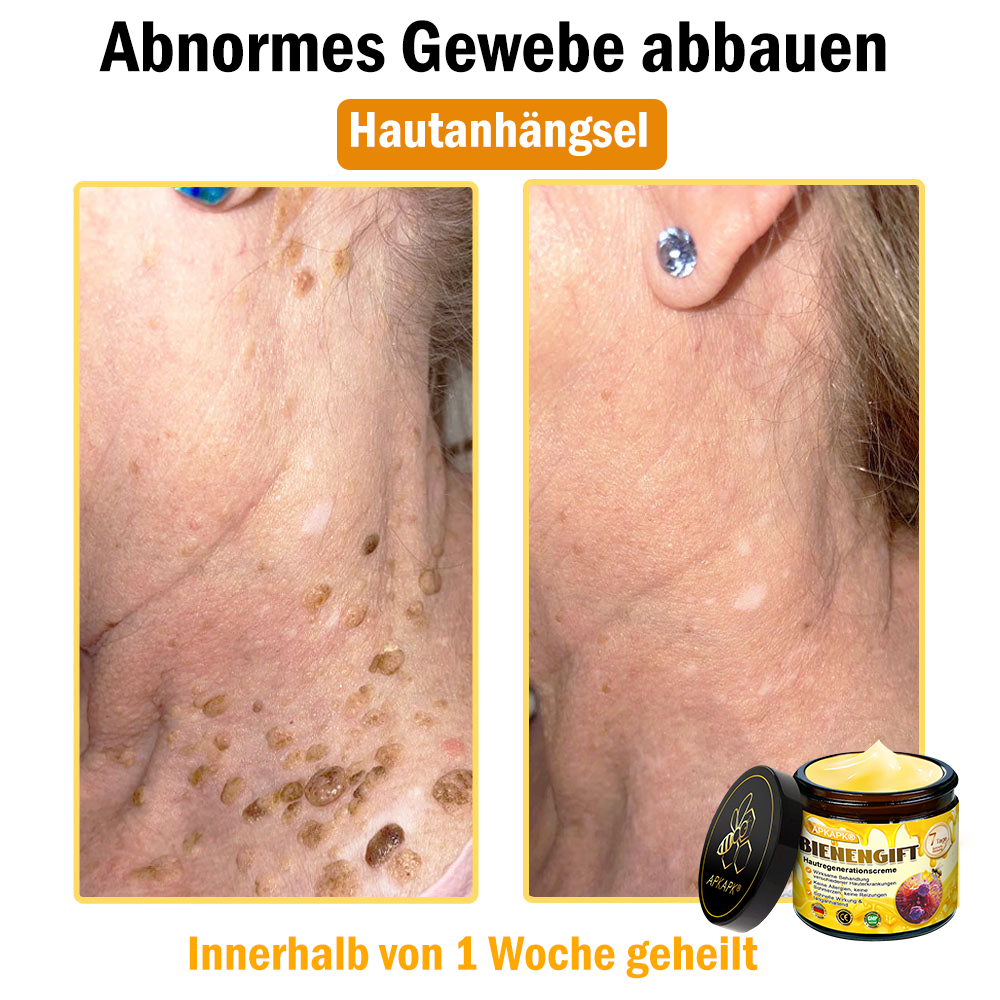 Hergestellt in Deutschland ✨APKAPK® Bienengift Hautregenerations creme – Anti-Aging, Feuchtigkeitsspendend, Hautreparatur, Hautbildverbesserung, Akne- und Pigmentfleckenbehandlung, Warzen- und Muttermalentfernung, Linderung bei Psoriasis