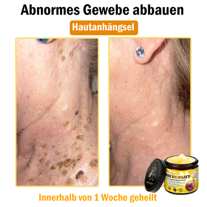 Hergestellt in Deutschland ✨APKAPK® Bienengift Hautregenerations creme – Anti-Aging, Feuchtigkeitsspendend, Hautreparatur, Hautbildverbesserung, Akne- und Pigmentfleckenbehandlung, Warzen- und Muttermalentfernung, Linderung bei Psoriasis