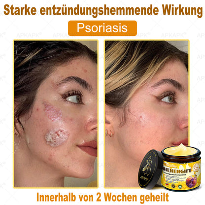Hergestellt in Deutschland ✨APKAPK® Bienengift Hautregenerations creme – Anti-Aging, Feuchtigkeitsspendend, Hautreparatur, Hautbildverbesserung, Akne- und Pigmentfleckenbehandlung, Warzen- und Muttermalentfernung, Linderung bei Psoriasis