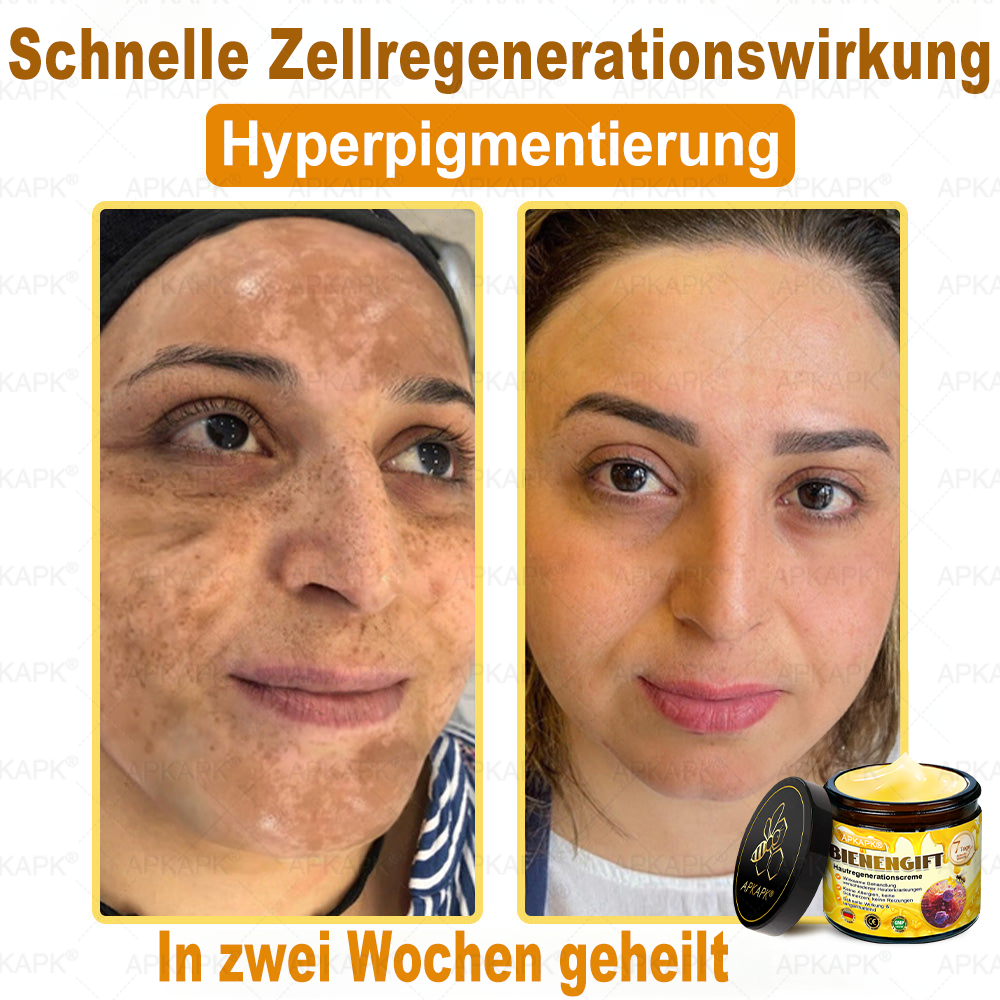 Hergestellt in Deutschland ✨APKAPK® Bienengift Hautregenerations creme – Anti-Aging, Feuchtigkeitsspendend, Hautreparatur, Hautbildverbesserung, Akne- und Pigmentfleckenbehandlung, Warzen- und Muttermalentfernung, Linderung bei Psoriasis