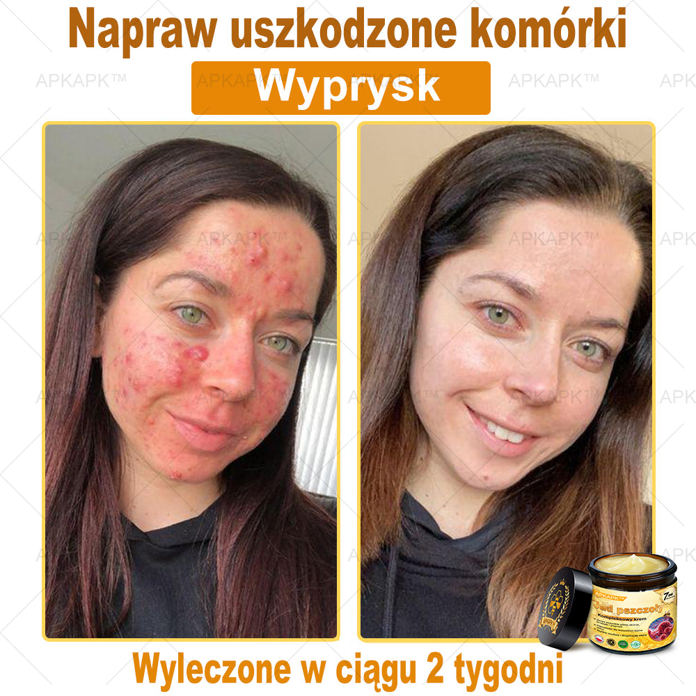 ΑPΚΑPK™ Jad Pszczoły Kompleksowy Krem🥇🥇pomaga w leczeniu problemów skórnych, takich jak: zmarszczki, blizny, plamy pigmentacyjne, rozstępy, trądzik, łuszczyca, egzema, zmiany skórne, podrażnienia, stany zapalne i inne problemy skórne🔥