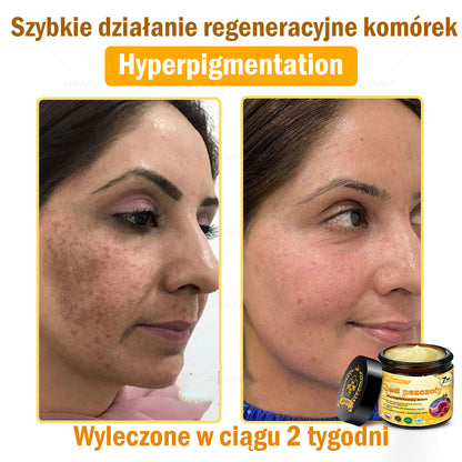 ΑPΚΑPK™ Jad Pszczoły Kompleksowy Krem🥇🥇pomaga w leczeniu problemów skórnych, takich jak: zmarszczki, blizny, plamy pigmentacyjne, rozstępy, trądzik, łuszczyca, egzema, zmiany skórne, podrażnienia, stany zapalne i inne problemy skórne🔥